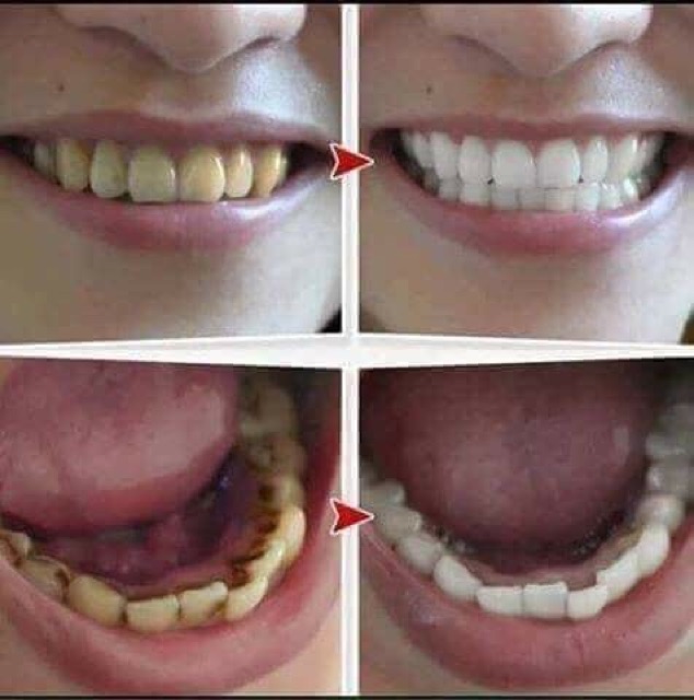 Trắng răng Than hoạt tính