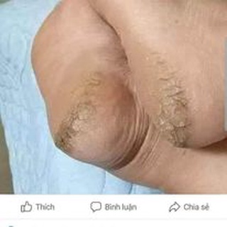 (Hộp 20 Sáp) nứt gót chân Thái Lan
