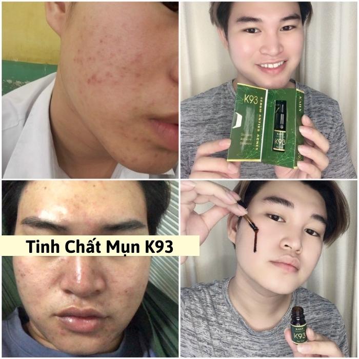 Tinh Chất Mụn K93 - Serum Giảm Mụn, Mờ Thâm Mụn Sẹo, Nâng Tông Da Công Dụng 5 Trong 1 Hiệu Quả Sau 7 Ngày-KAILY COSMETIC