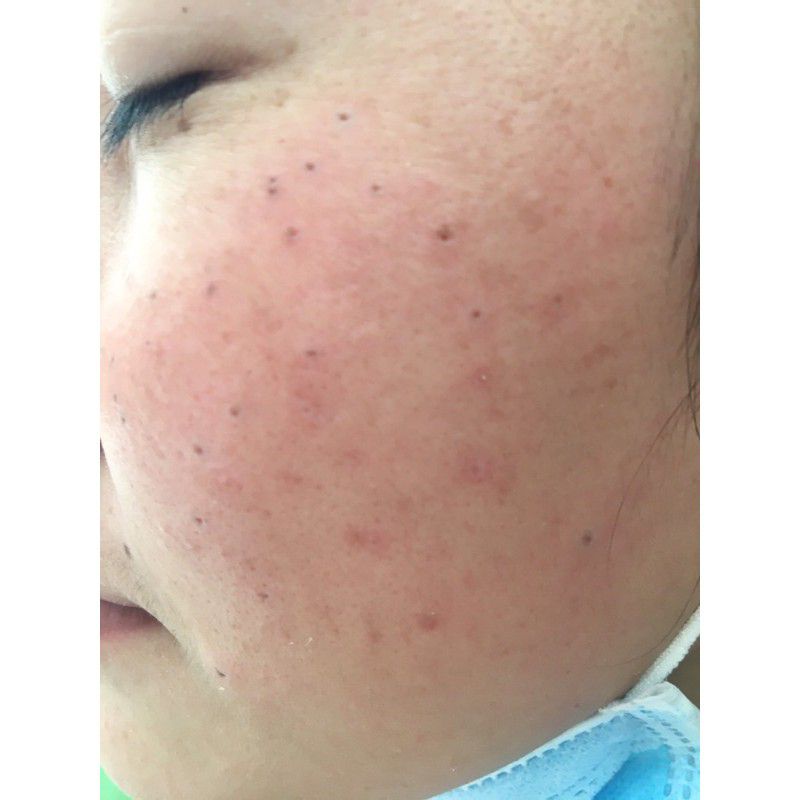 💥💥Chấm nám chân sâu,sẹo rỗ đức thịnh handmade 1ml | BigBuy360 - bigbuy360.vn