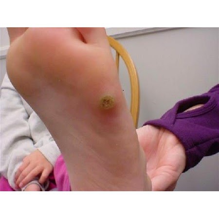 Dứt điểm mụn cóc lòng bàn tay, bàn chân | BigBuy360 - bigbuy360.vn