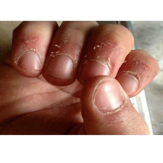 Thảo dược đánh bay XƯỚC MĂNG RÔ các đầu ngón tay, mé móng tay, lấy da thừa móng tay, chân_Sẵn Có