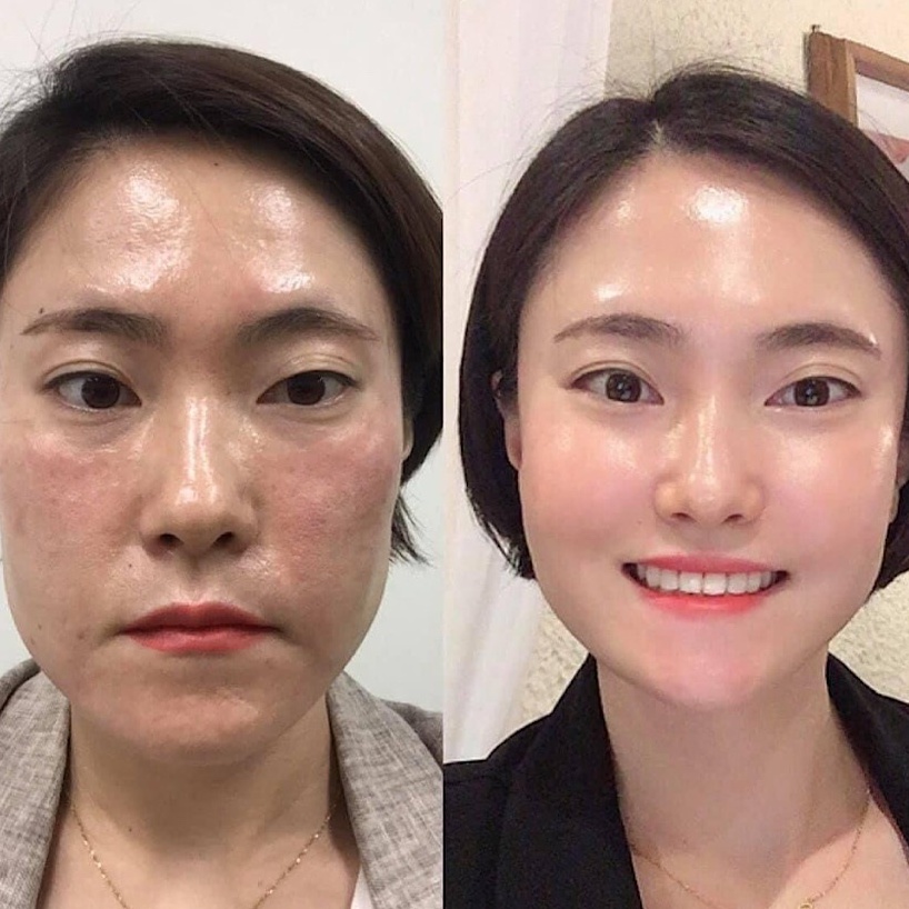 Ống Sample Peel da CNP Rx Skin Rejuvenating Intensive giúp tái tạo da chuyên sâu, làm trắng và siêu căng bóng da