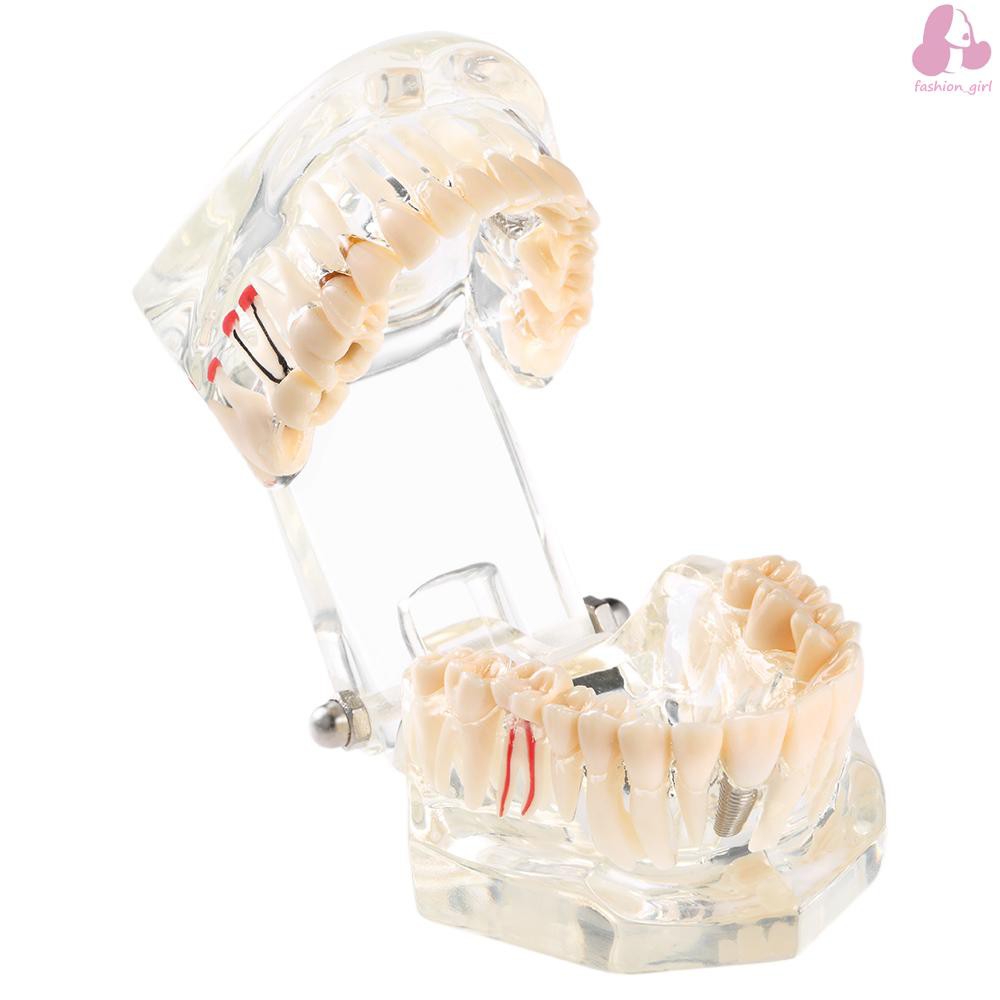 Mô hình hàm răng trong suốt dạy học việc cấy răng có thể tháo rời cho nha khoa