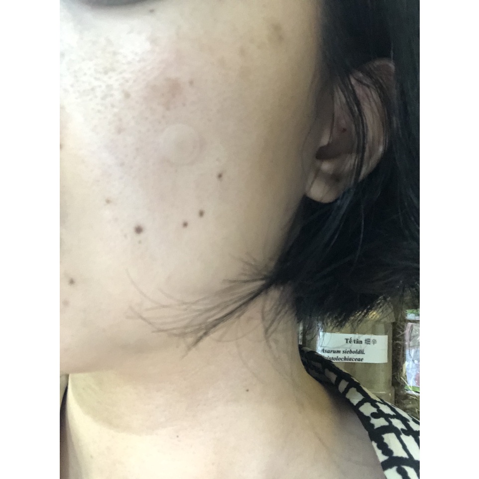 Miếng dán mụn Medy tinh chất rau má - xẹp mụn viêm sau 24h.