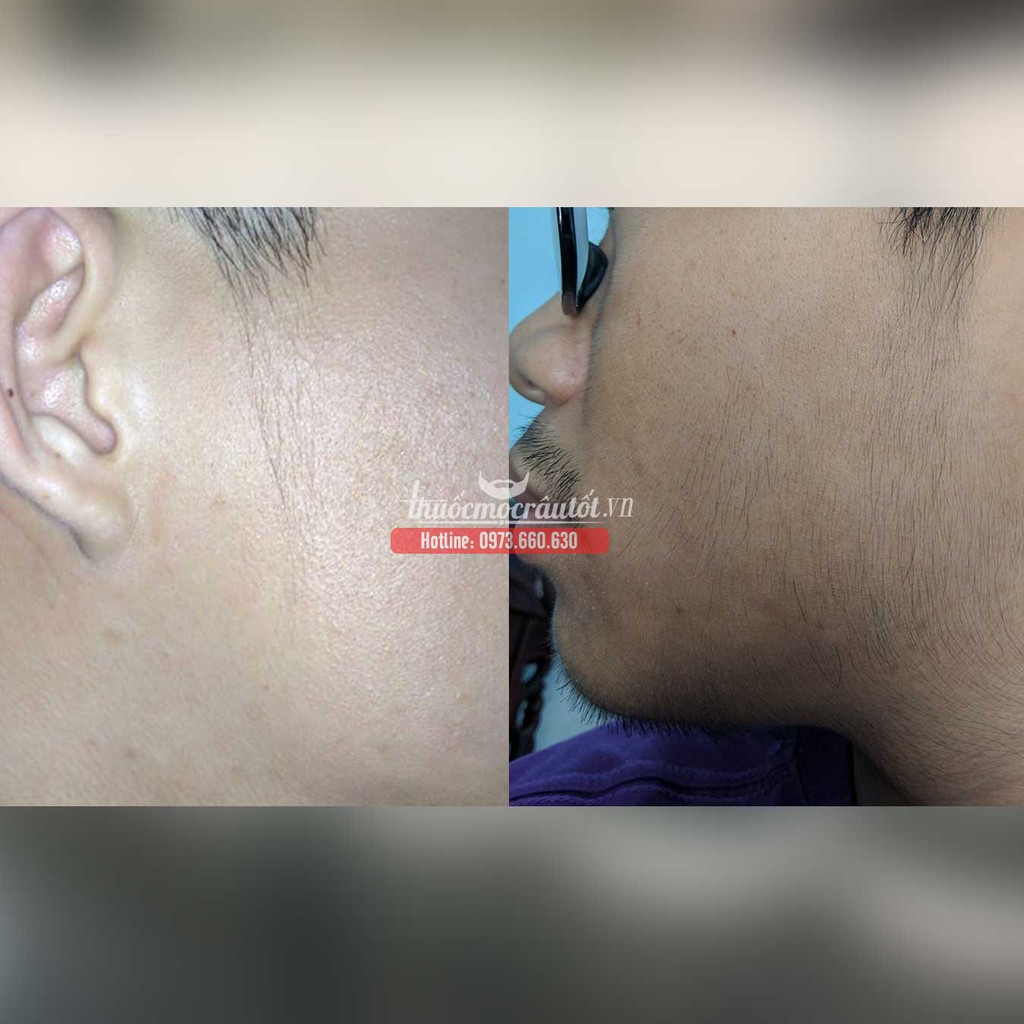 Thuốc mọc râu minoxidil 5%