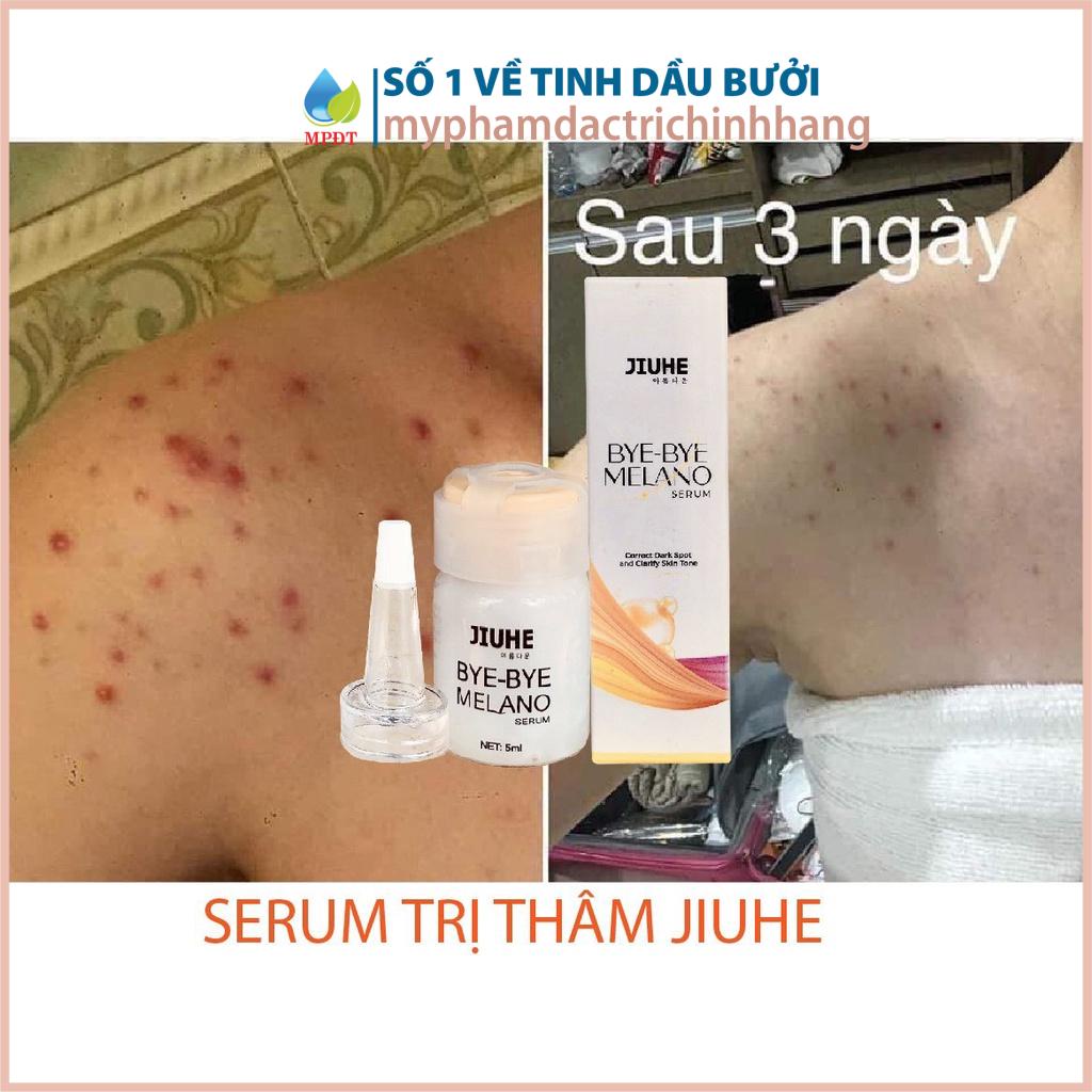 Serum xóa thâm Jiuhe 5ml skkh