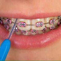 Combo 4 bộ bàn chải kẽ răng shining teeth