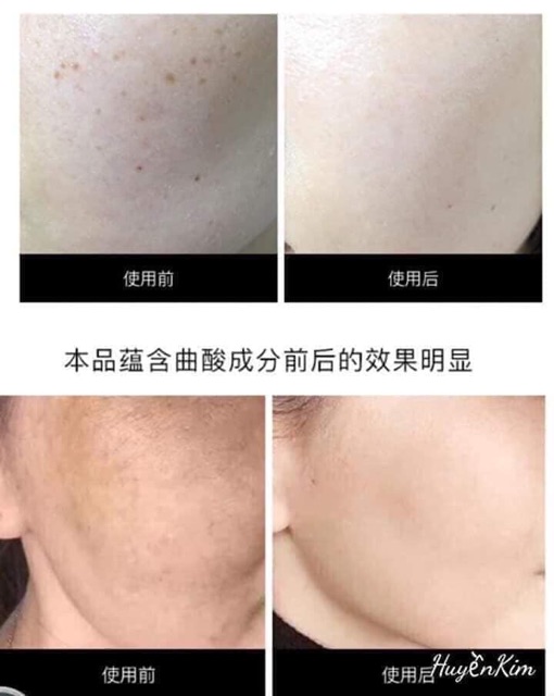 KEM NÁM DONGSUN MINI Cao Cấp