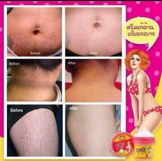 Cream trị rạn da OHO Thái Lan