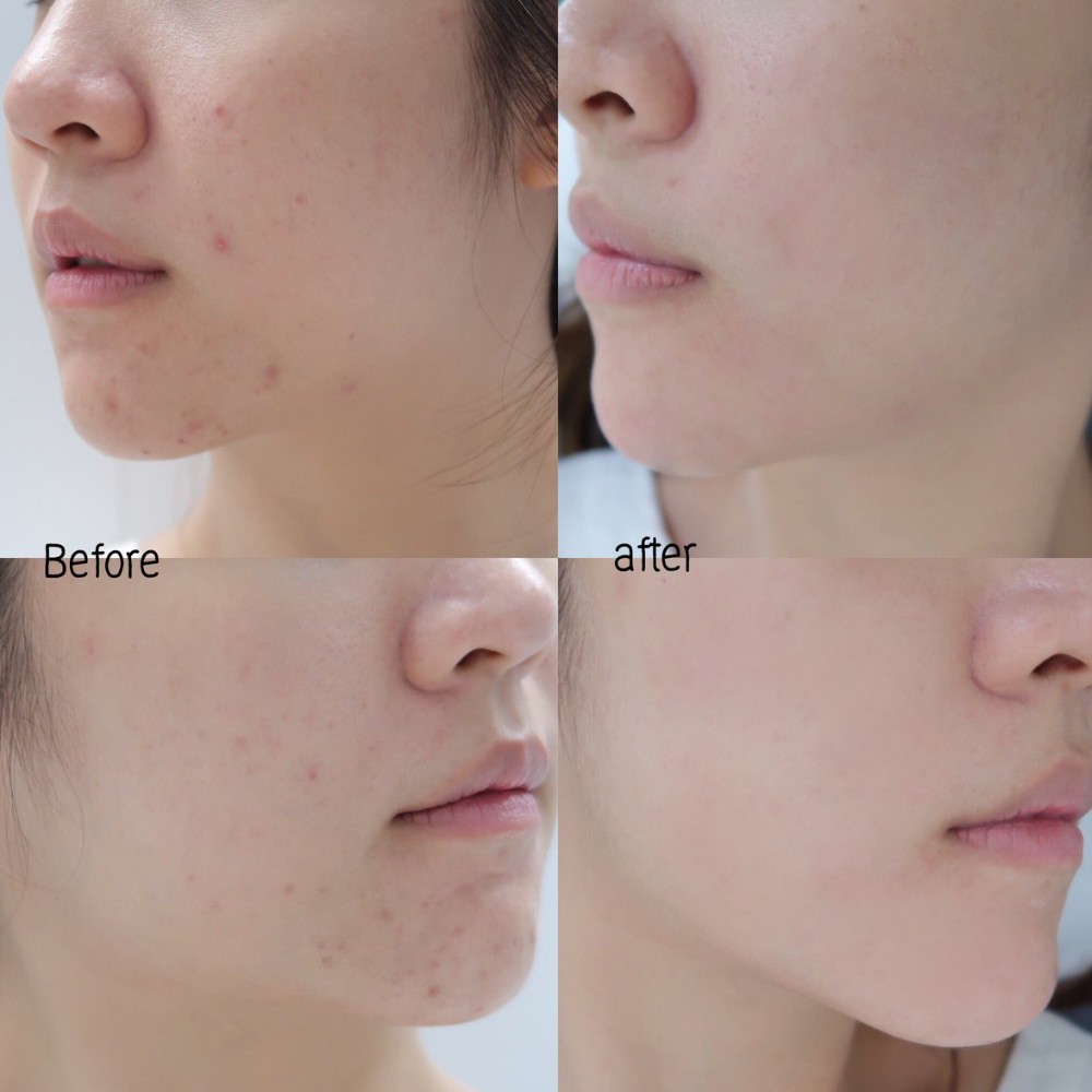 Tinh chất tràm trà giả mụn Serum Derladie Herbal Ampoule For Blemish