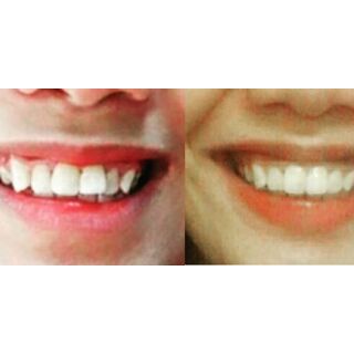 (A1+A2+A3) DỤNG CỤ NIỀNG RĂNG CHO NGƯỜI LỚN