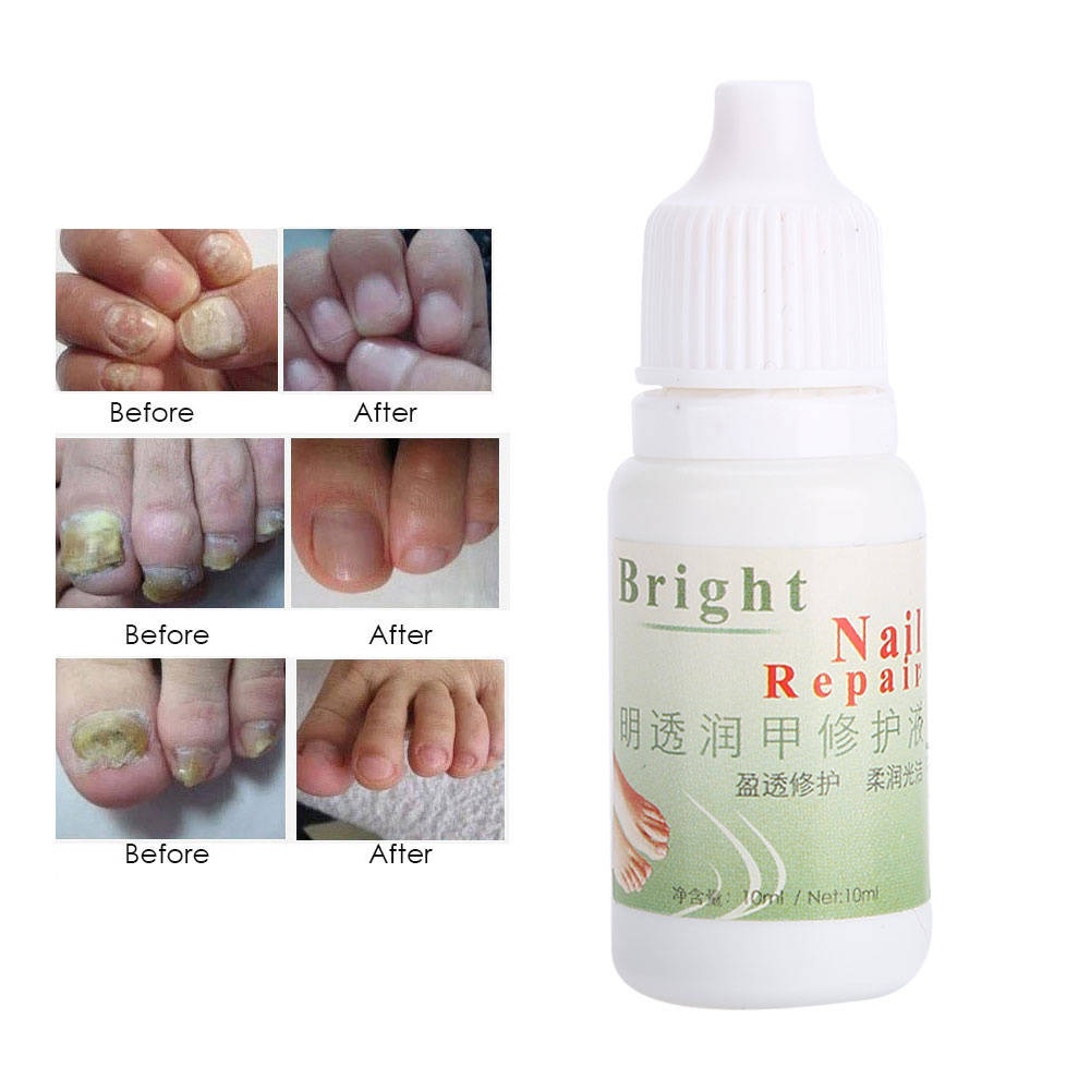 Tinh chất loại bỏ nấm móng tay tự nhiên dạng lỏng chăm sóc tiện lợi 10ml