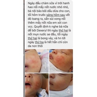 Kem chàm nẻ Dexeryl