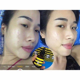 SERUM MỤN ẨN KOSXU