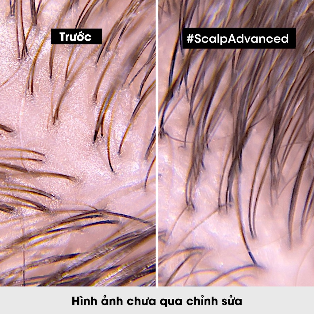Dầu gội dưỡng tóc giảm bã nhờn da đầu, giảm bết tóc Scalp Advanced 300ml - Dành cho da đầu dư dầu, tóc bết
