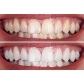 Miếng dán trắng răng 3D White teeth trắng răng sau 7 ngày