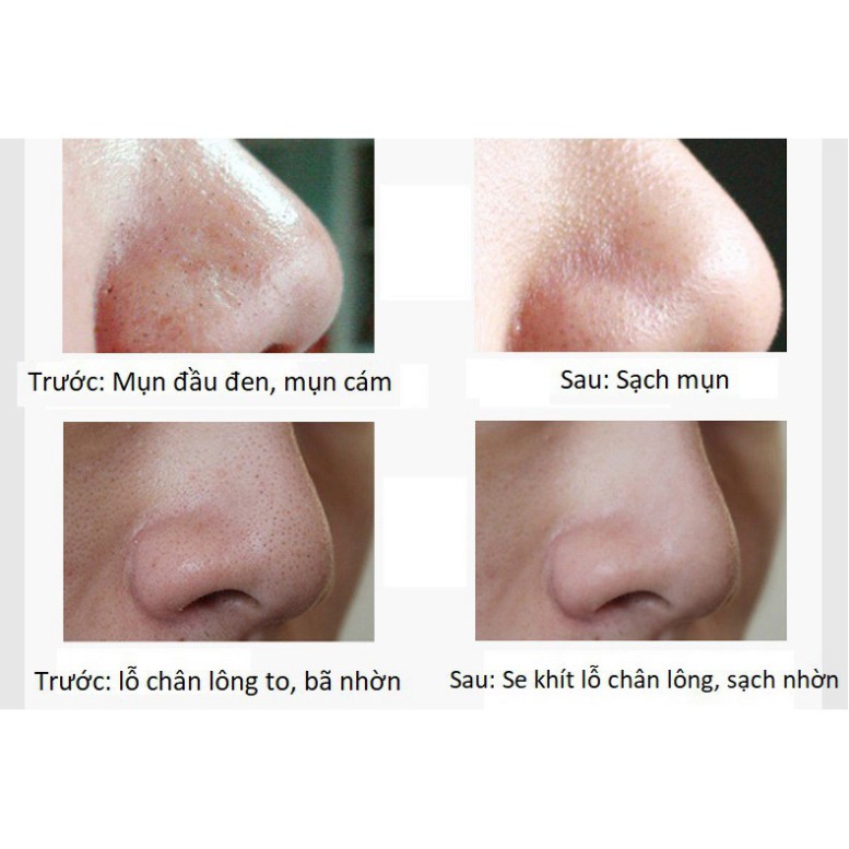 Gel lột mụn 💞FREESHIP💞 Miếng dán lột mụn than tre hoạt tính, lột mụn đầu đen, mụn cám