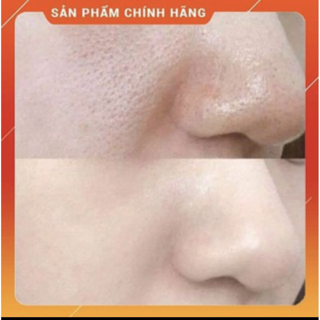 Tế Bào Gốc Giảm Lỗ Chân Lông To POCIA  Se Khít Lỗ Chân Lông Pocia