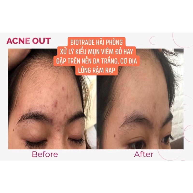 Kem Dưỡng Dành Cho Da Mụn- Biotrade Acne Out Hydro Active Cream