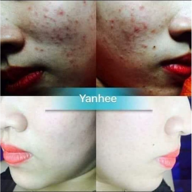 KEM YAHEE, XÓA MỤN,THÂM,NÁM,TÀN NHANG