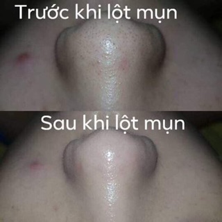 Gel lột mụn Huyền Phi 120k