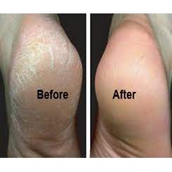 Dụng Cụ Chà, Dũa Gót Chân tiện dụng