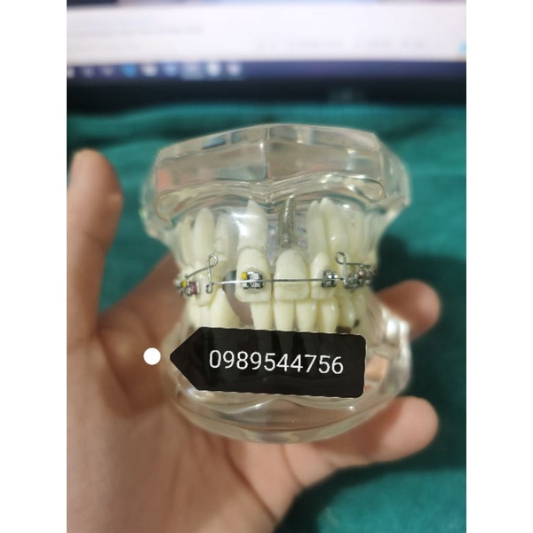 Cung ricketts Bio, cung đánh lún và kéo lui nhóm răng cửa