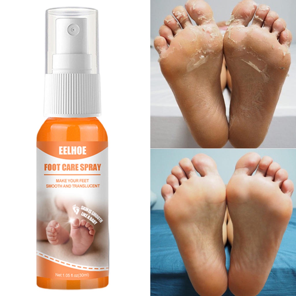 Bình xịt loại bỏ da chết cứng dưỡng ẩm cho da chân