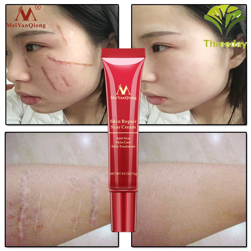 3D❤ Scar Repair Cream Skin Care Natural Acne Remove Burn Stretch Marks Scar Removal