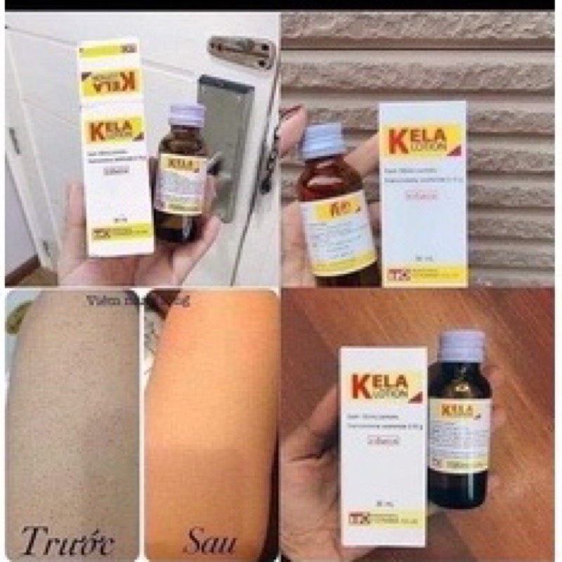 LOTION KELLA VIÊM LỖ CHÂN LÔNG,  VIEM DA THÁI LAN