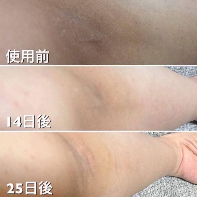 XÀ PHÒNG GIẢM THÂM NÁCH , KHUỶ TAY PELICAN | BigBuy360 - bigbuy360.vn