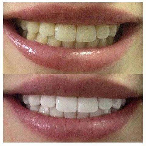 10 Miếng dán trắng răng siêu mạnh Professional Effects(5 gói)  tặng Vỉ 24 miếng ngậm thơm miệng Listerine Cool Mint