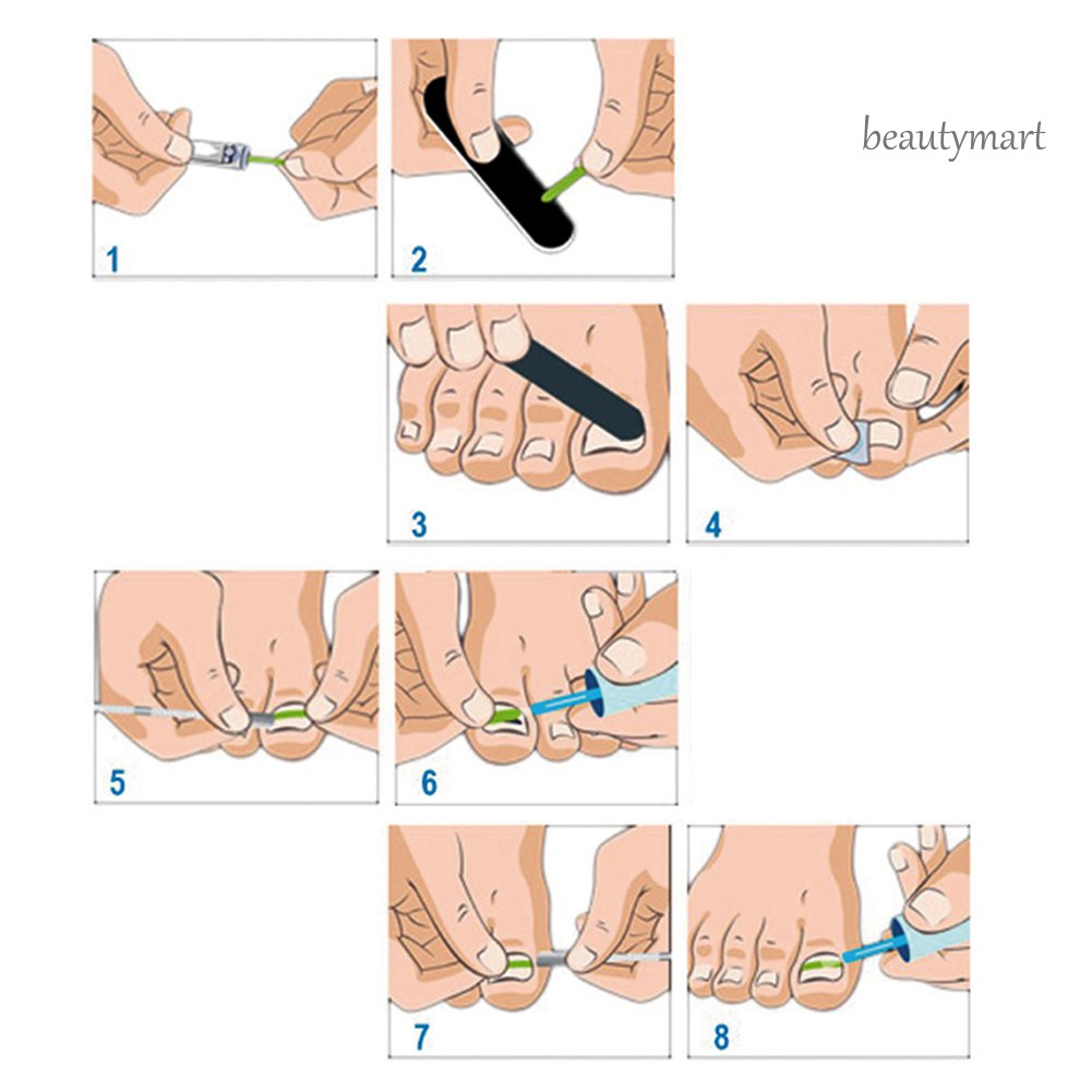 [Hàng mới về] Công cụ làm thẳng chỉnh móng chân mọc ngược