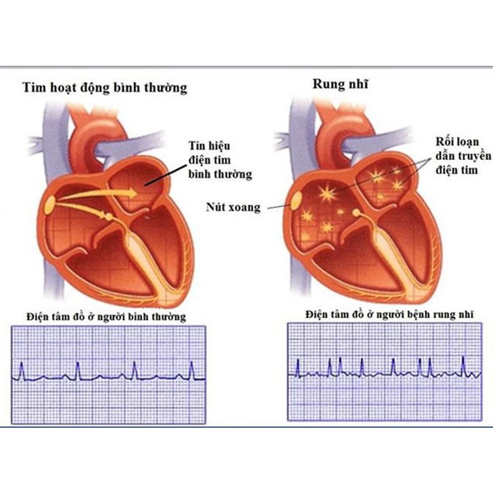 MÁY ĐO HUYẾT ÁP BẮP TAY MICROLIFE B3 AFIB ADVANCED ĐIỆN TỬ TỰ ĐỘNG - CHÍNH HÃNG - THỤY SỸ