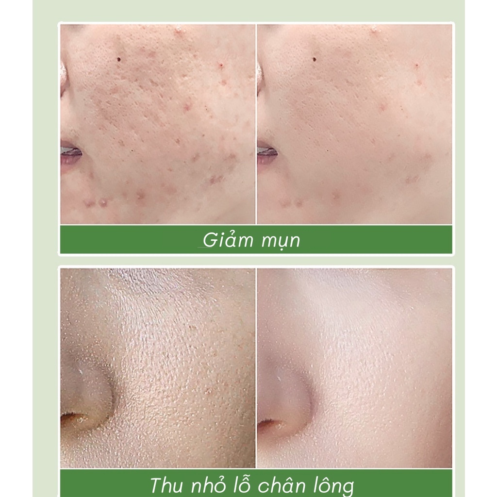 Mặt Nạ Sủi Bọt Rau Má GinBi Thải Độc, Sạch Mụn Đầu Đen Và Làm Sáng Da – ACL733