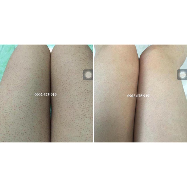 Viêm Nang Lông, Cửa hàng trực tuyến | BigBuy360 - bigbuy360.vn