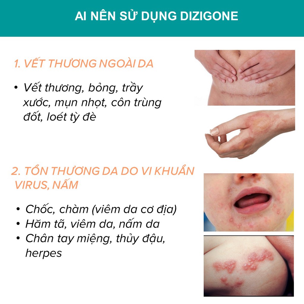 [BỘ ĐÔI] Dung dịch DIZIGONE 300ml và Kem DIZIGONE NANO BẠC: kháng khuẩn, tái tạo da, ngăn ngừa sẹo