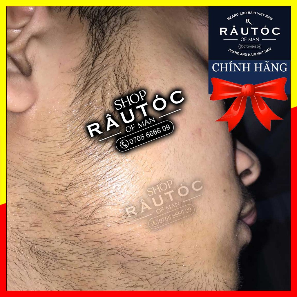 Thuốc mọc râu Minoxidil 5% dạng Foam