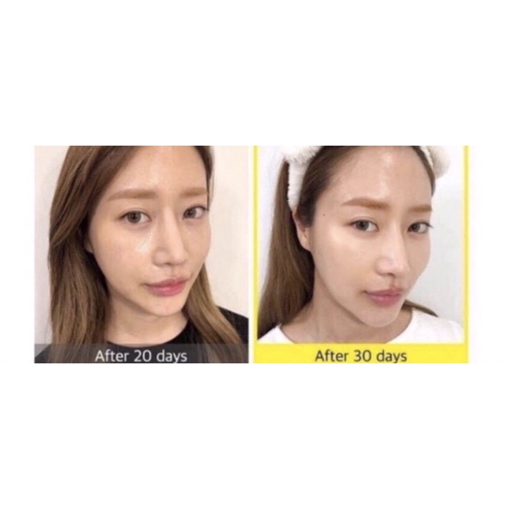 Cao Nám làm giảm làm mờ nám Lumiderm