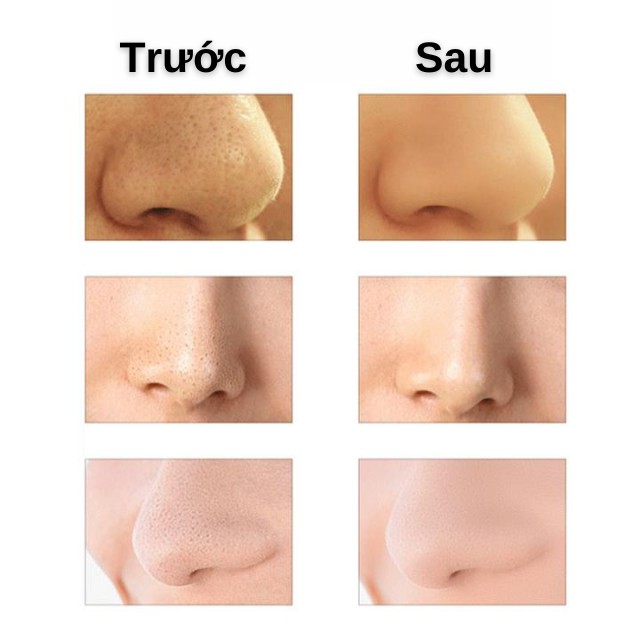 Máy Hút Mụn, Đầu Đen Cám Bọc Cầm Tay Mini Blackhead Spa Hút Nặn Mụn Trứng Cá Tặng 6 Đầu Hút Đa Năng | BigBuy360 - bigbuy360.vn