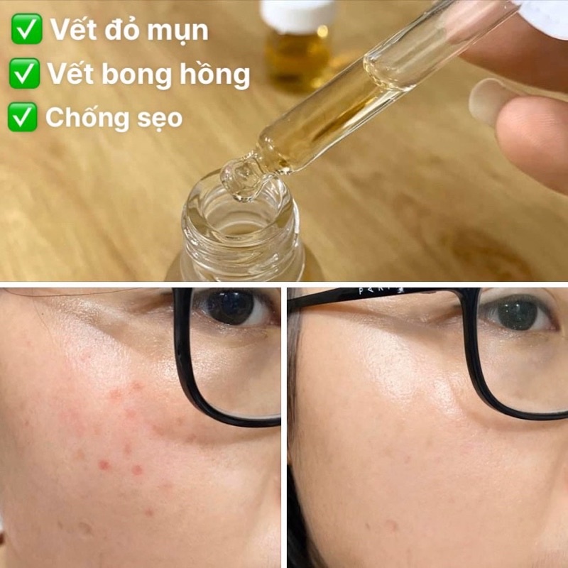 Tinh chất phục hồi mạnh C2 phục hồi thâm đỏ, giúp da dày khỏe, dưỡng ẩm, làm dịu Handmade