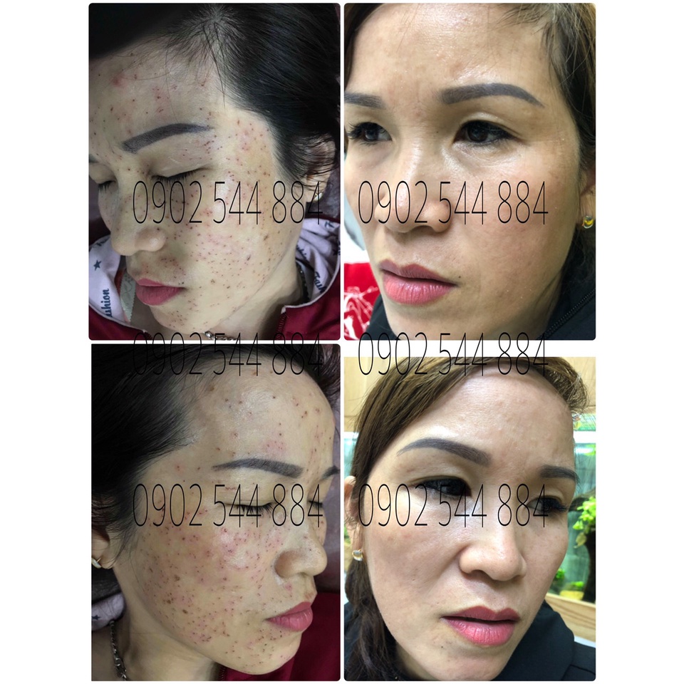 Serum nám Hoàng Trinh