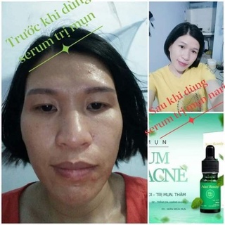 SERUM  MỤN