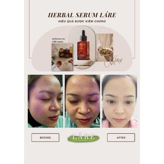 HERBAL SERUM (THANH DƯỢC LÁRE) FULL SIZE 80ML
