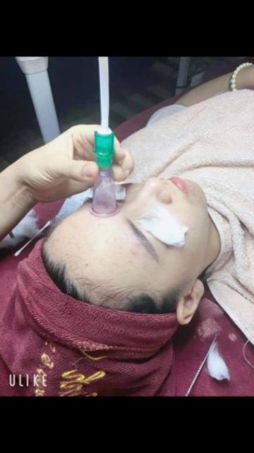 Bộ ống hút mụn máu bầm