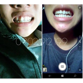 Dụng cụ niềng răng