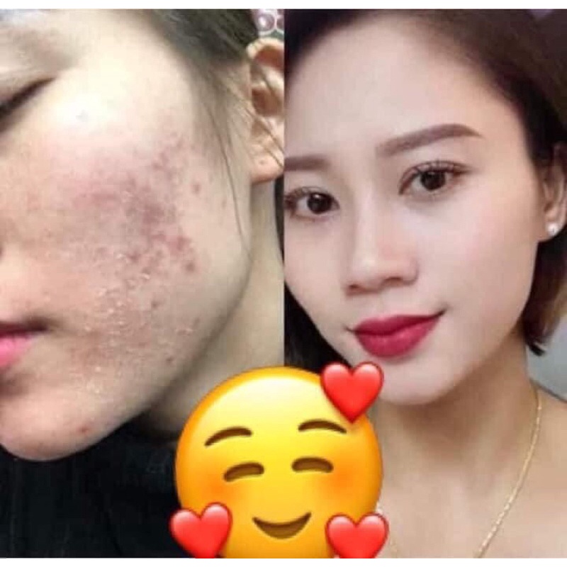 Set NÁM cao cấp CLOBETAMILG Thái Lan Gồm 4 Món