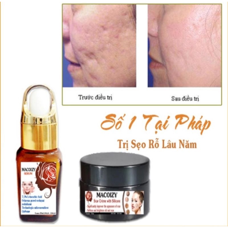 Combo serum Macoizy & Kem Xóa Sẹo rỗ