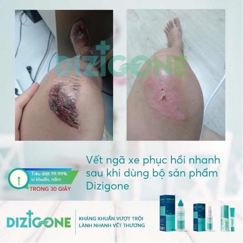 Xịt Dizigone làm sạch da